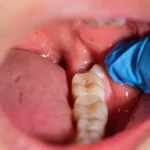 Removal of Wisdom Tooth