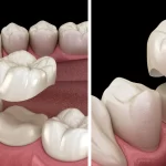 Which material is the best for a dental crown