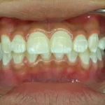 white spots on teeth