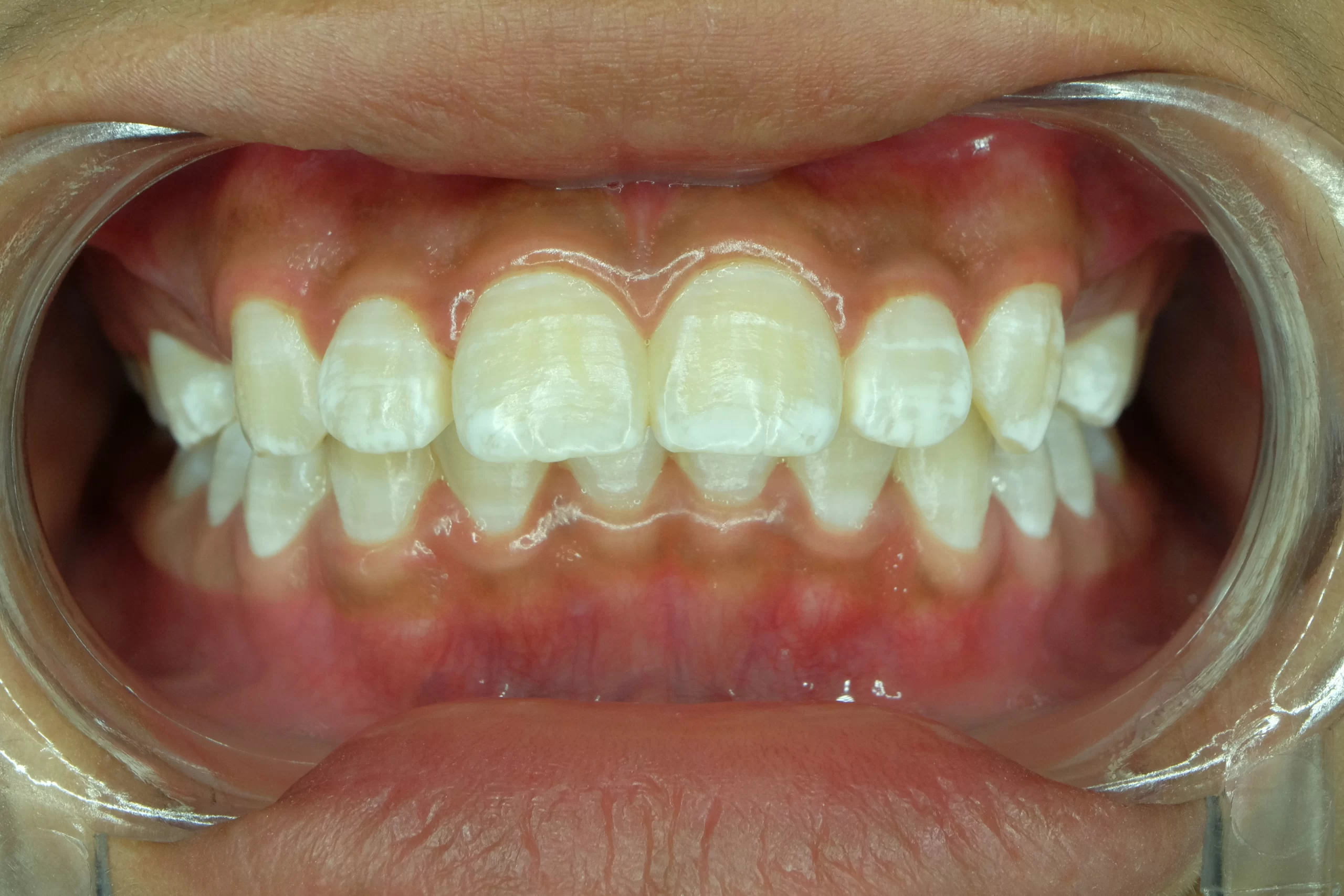 white spots on teeth